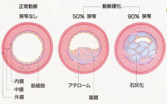 冠動脈硬化の進行の図