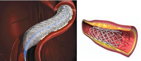 冠動脈内へのステントの挿入と留置の図