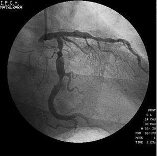 経皮的冠動脈形成術(PCI)の実際の画像