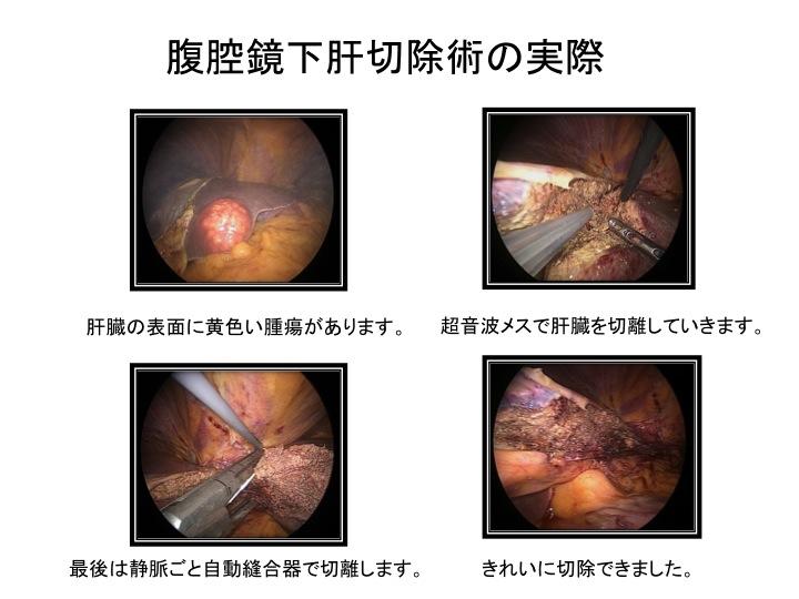 肝部分切除術