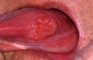 舌のがんの写真