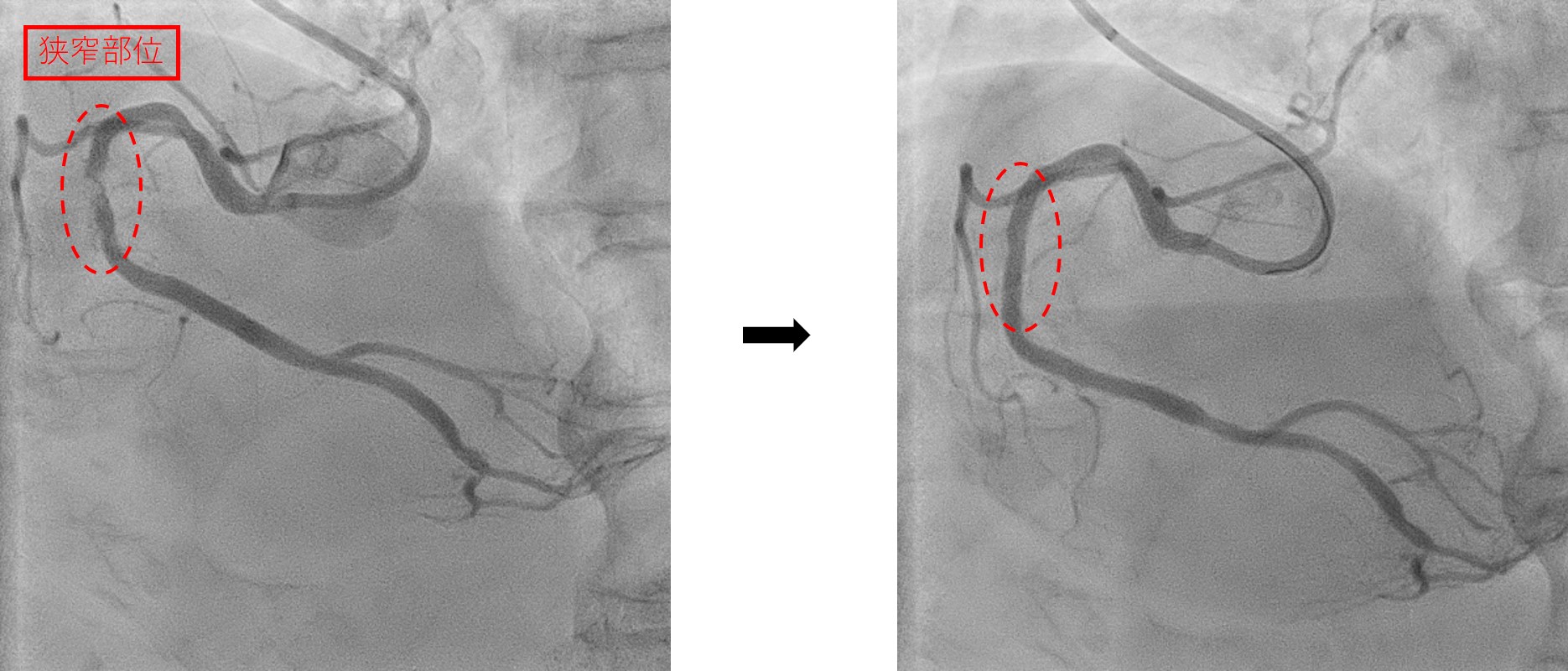 （左画像）右冠状動脈治療前　（右画像）右冠状動脈治療後