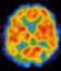 脳血量シンチグラムの画像